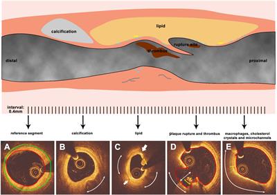 Morphological and Physiological Characteristics of Ruptured Plaques in Native Arteries and Neoatherosclerotic Segments: An OCT-Based and Computational Fluid Dynamics Study